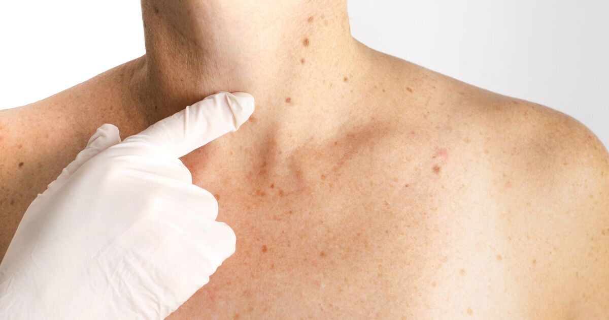 Dermatologist shares most common signs of skin cancer you need to watch out for