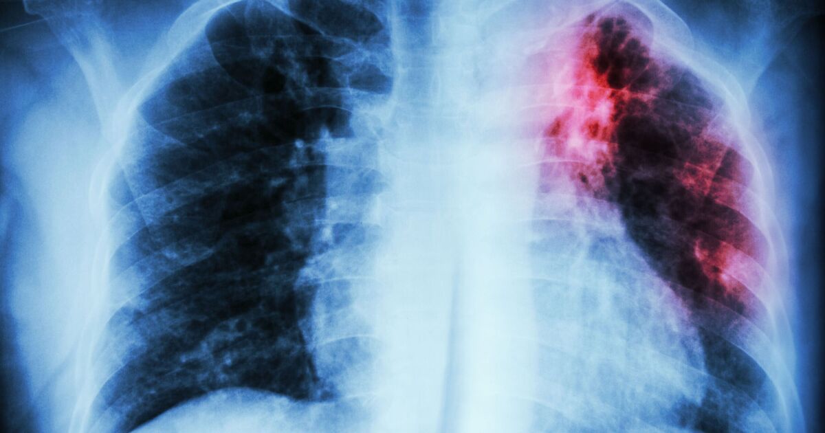 New migration bombshell as health chiefs blame arrivals for explosion in TB cases