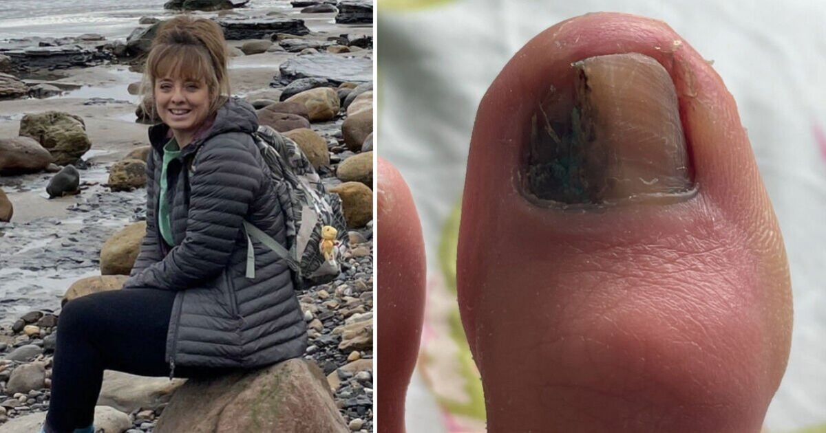 &#039;My doctor told me the mark on my toenail was an infection - but it was cancer&#039;